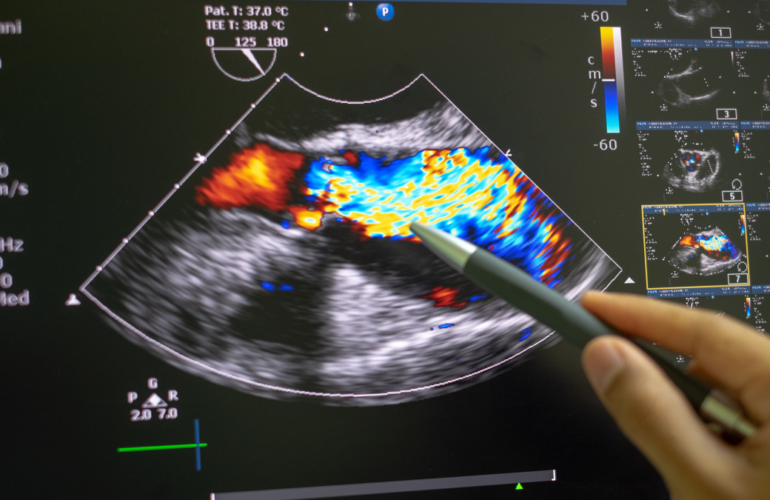 Echocardiography at Northern Heart Hospital - Non-Invasive Cardiac Imaging