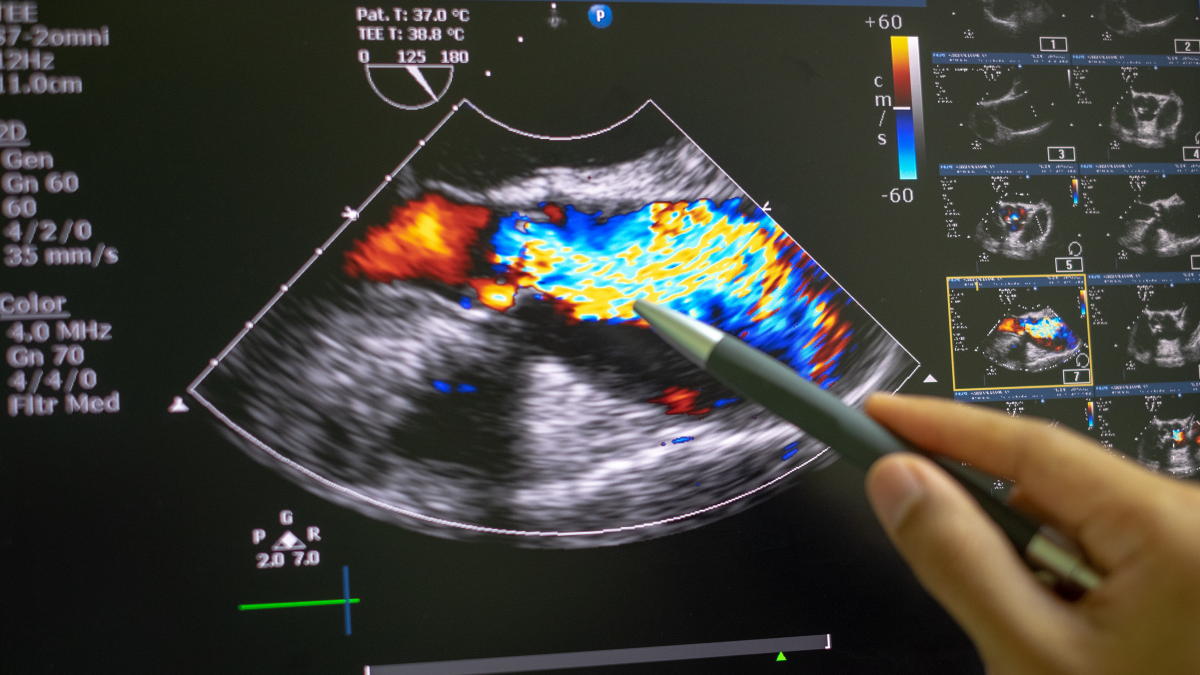 Echocardiography at Northern Heart Hospital - Non-Invasive Cardiac Imaging