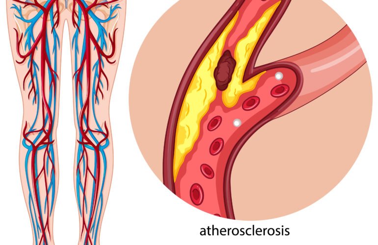 Diagram showing narrowed arteries due to Peripheral Arterial Disease (PAD).