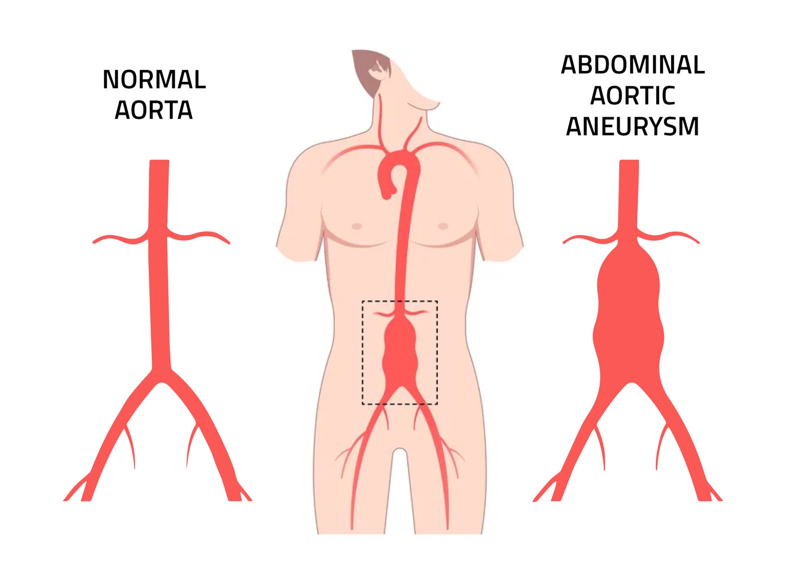 Diagram comparing a normal aorta with an abdominal aortic aneurysm