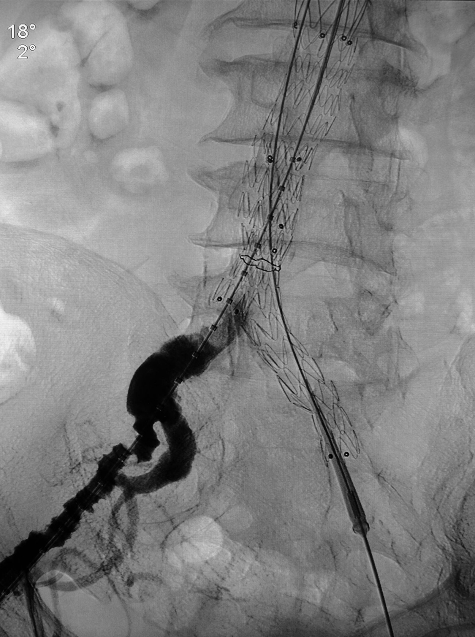 X-ray image showing endovascular stent placement for abdominal aortic aneurysm repair