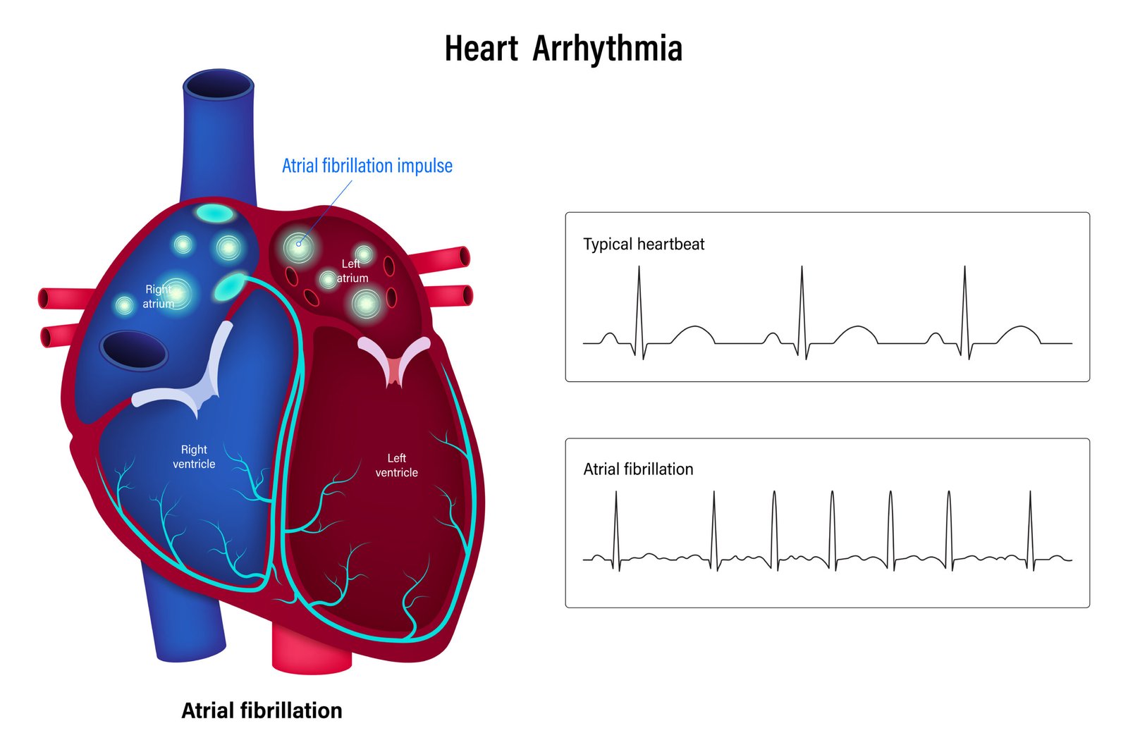 Advanced 3D mapping technology used in Pulsed Field Ablation at Northern Heart Hospital.
