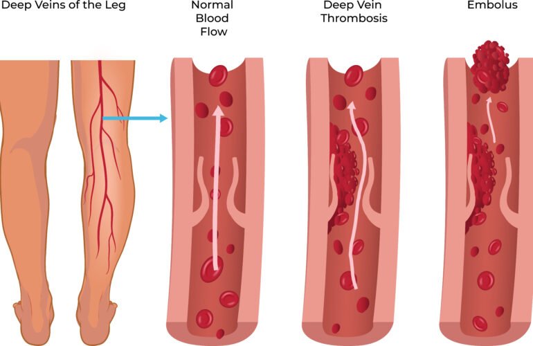 Deep Vein Thrombosis