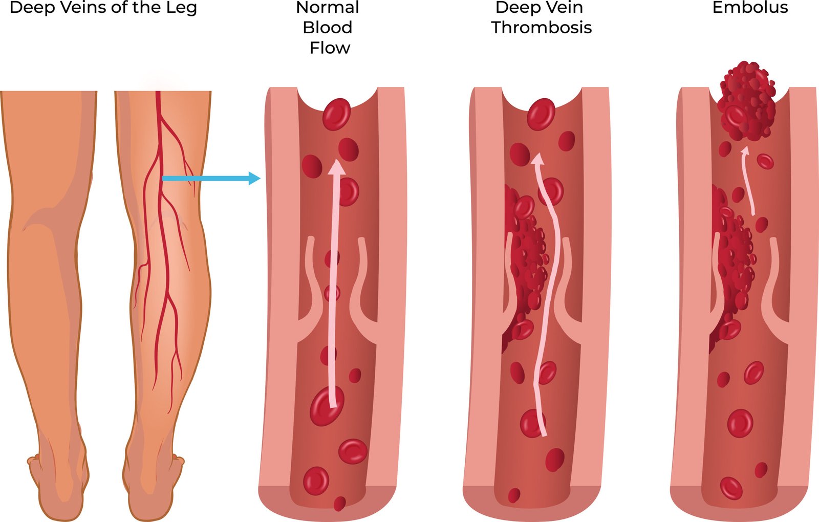 Deep Vein Thrombosis