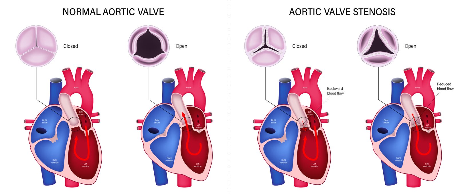 Diagram comparing a normal aortic valve and a stenotic aortic valve, highlighting differences in blood flow.
