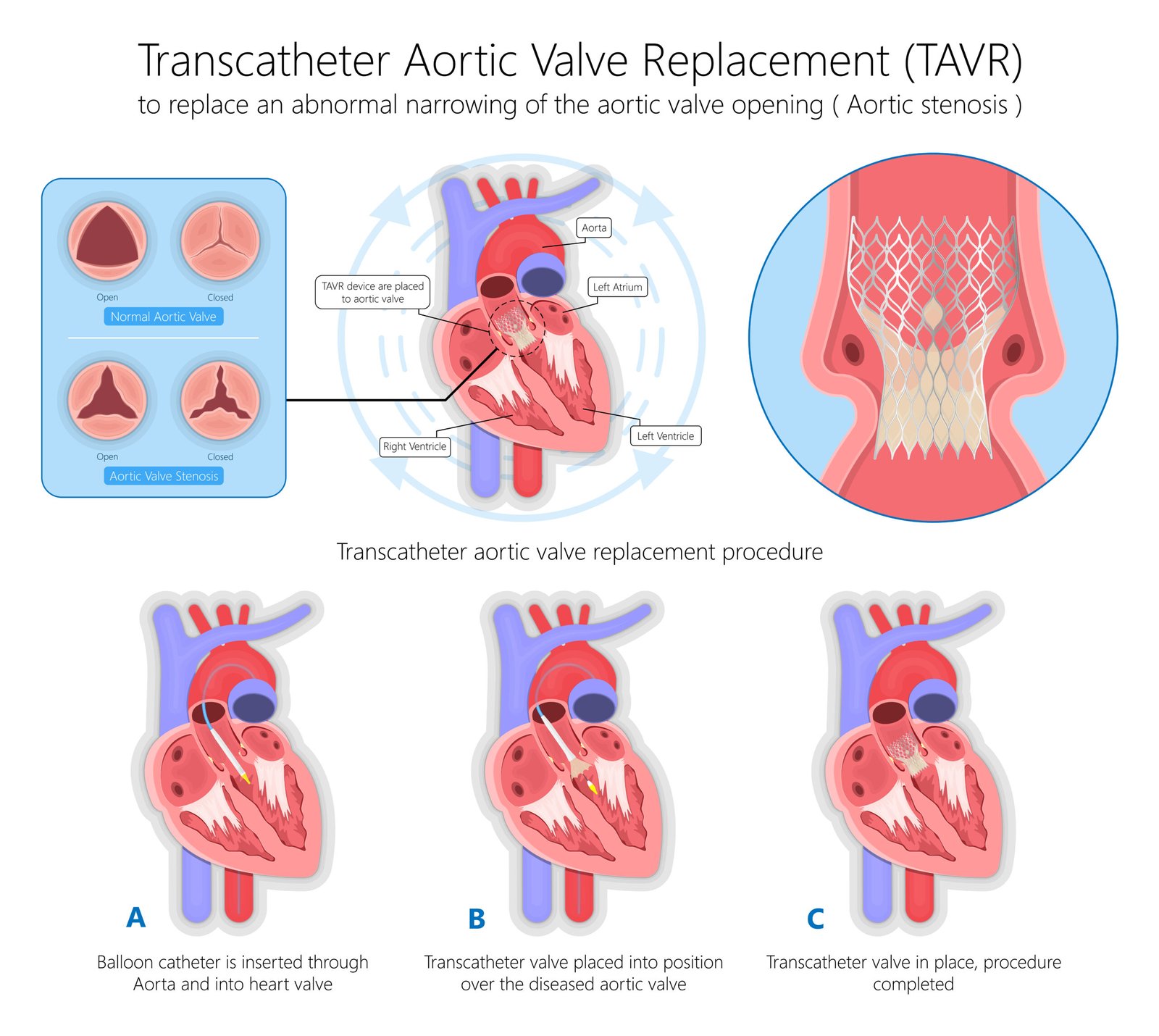 Illustration of Transcatheter Aortic Valve Replacement (TAVI) procedure steps, showing aortic valve stenosis treatment.
