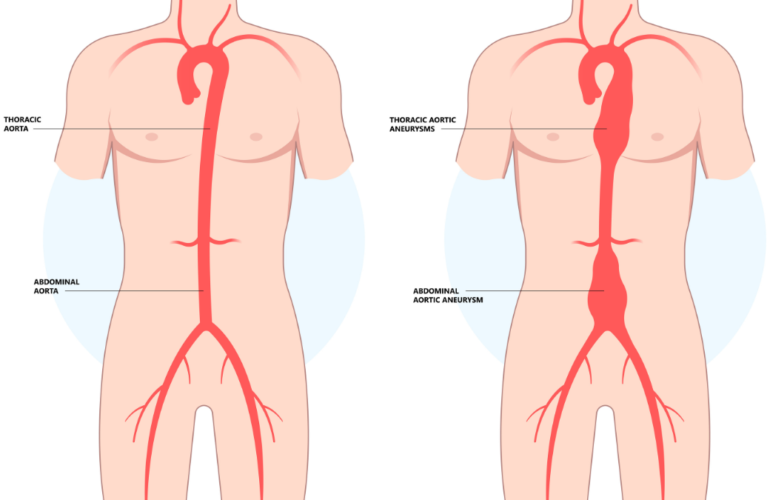 Abdominal Aortic Aneurysm (AAA)