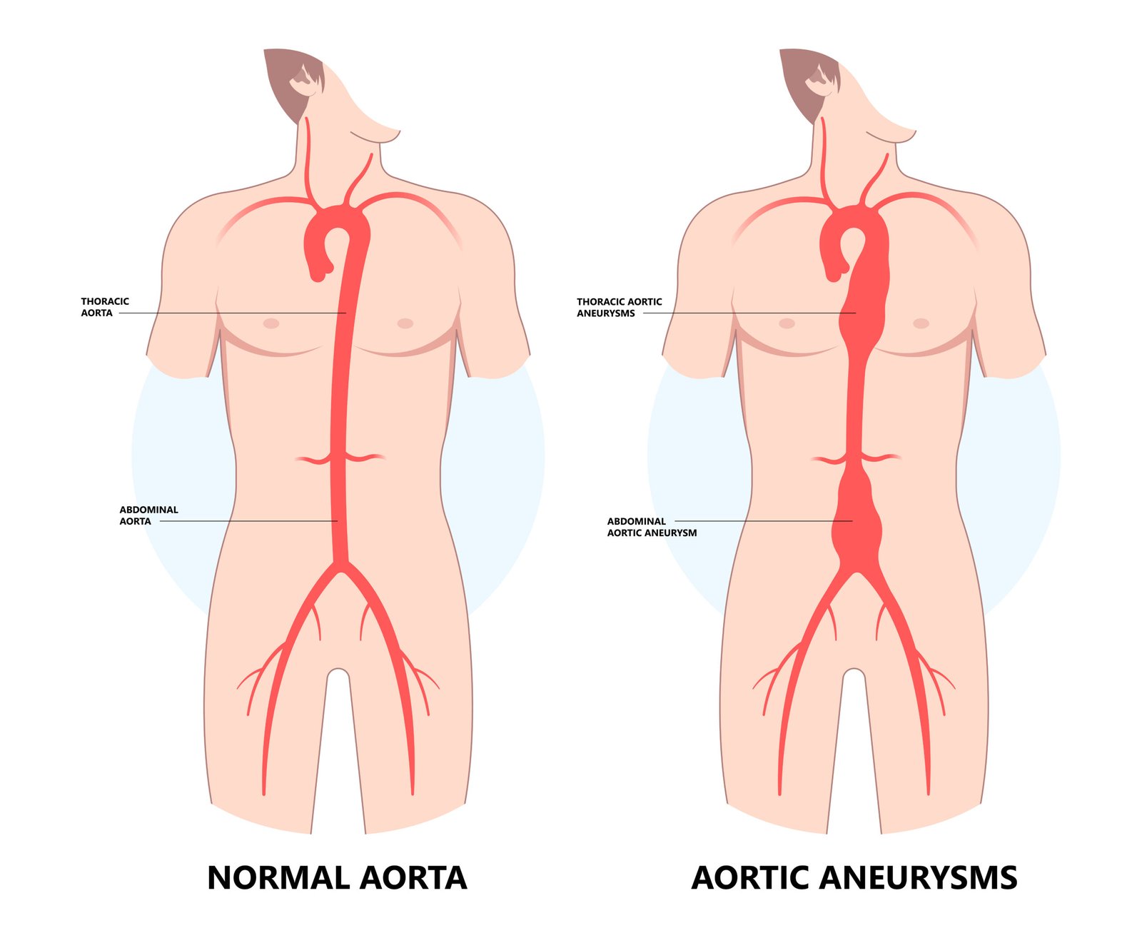 Abdominal Aortic Aneurysm (AAA)