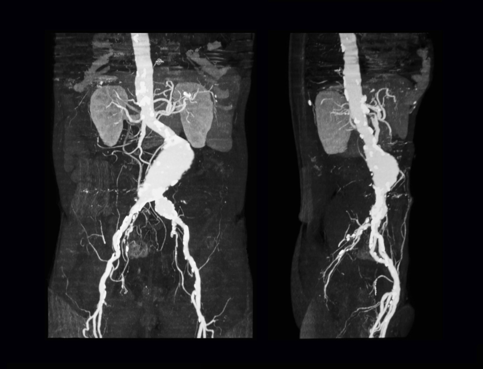 Computed tomography angiography (CT Angiography or CTA) of abdominal aorta – case of abdominal aortic aneurysm, prone view (left) and lateral view (right)