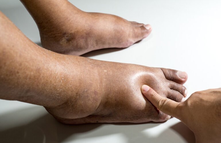 Diabetic Foot