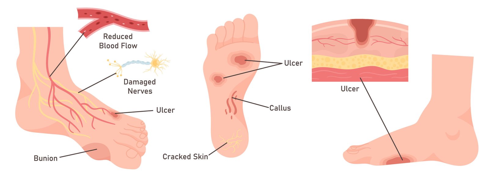 Diabetic Foot Diseases Set Vector Illustration