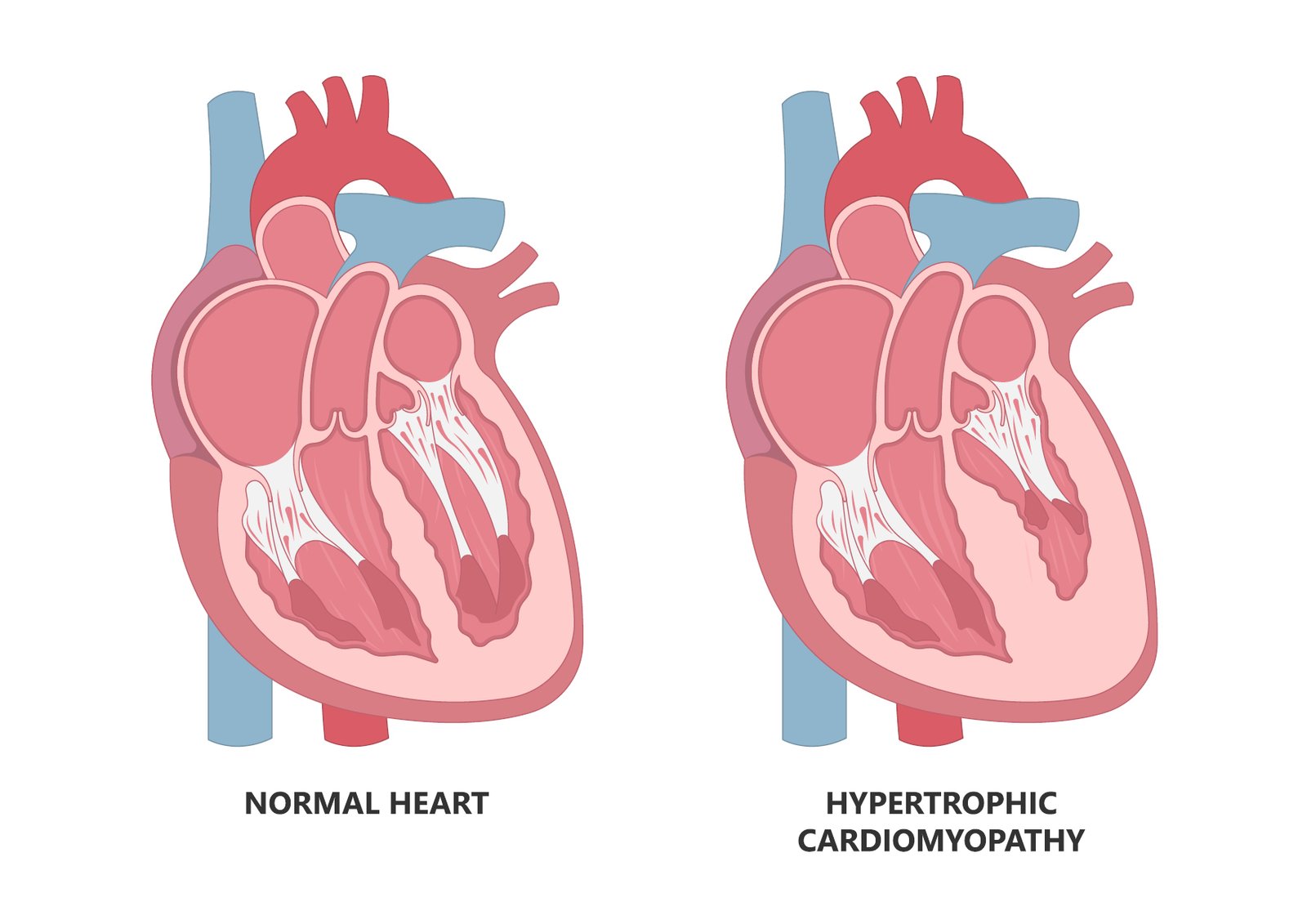 CardioMyopathy