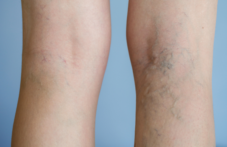 Varicose Veins