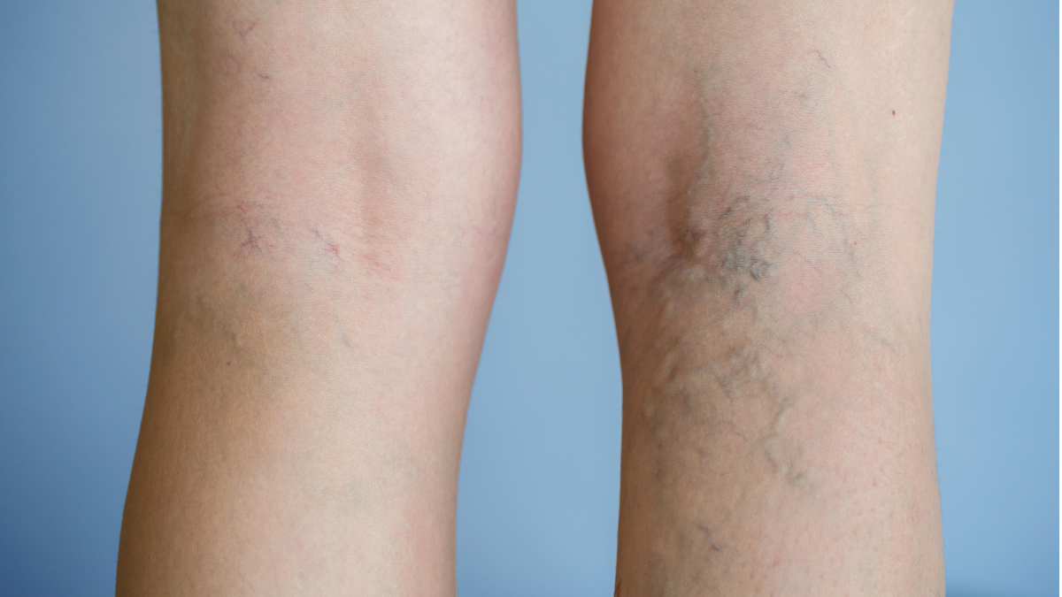 Varicose Veins