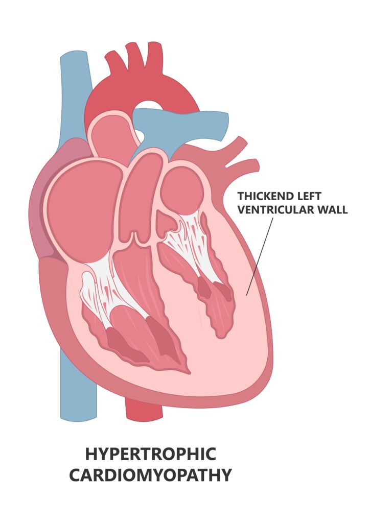 Hypertrophic Cardiomyopathy (HCM)