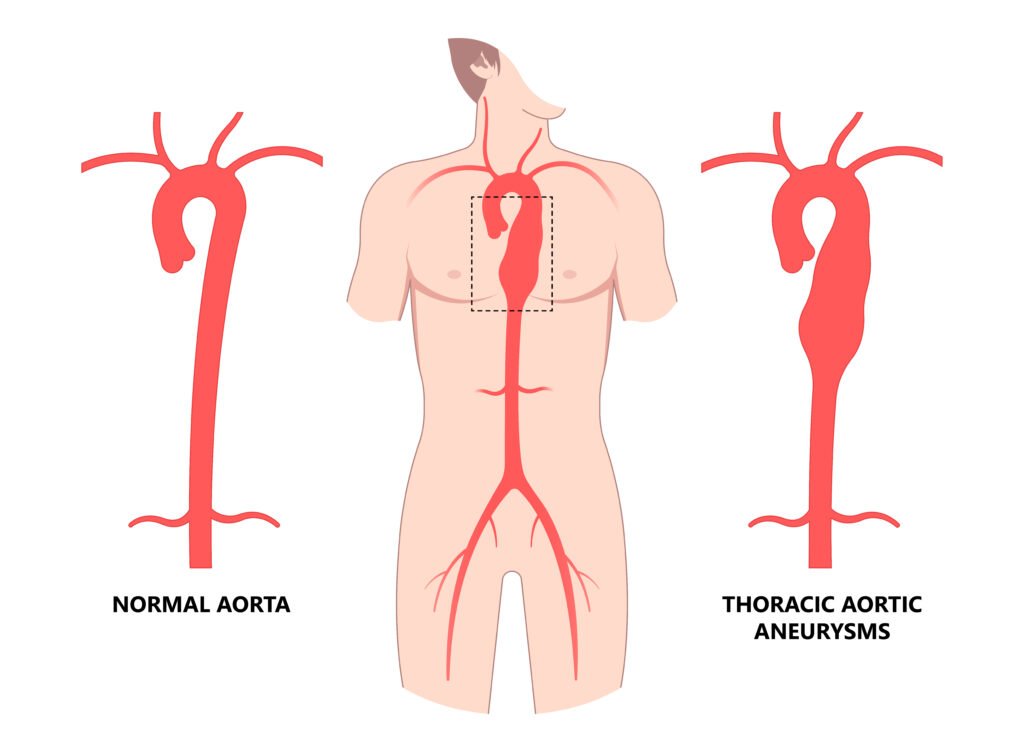 Understanding Thoracoabdominal Aortic Aneurysm and Its Treatment Challenges