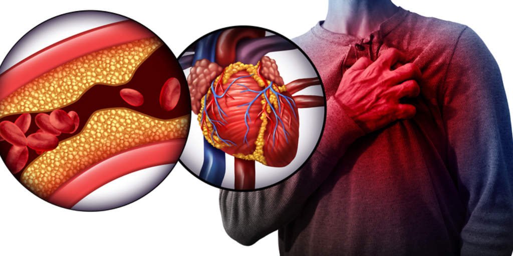 Understanding Acute Myocardial Infarction - Causes