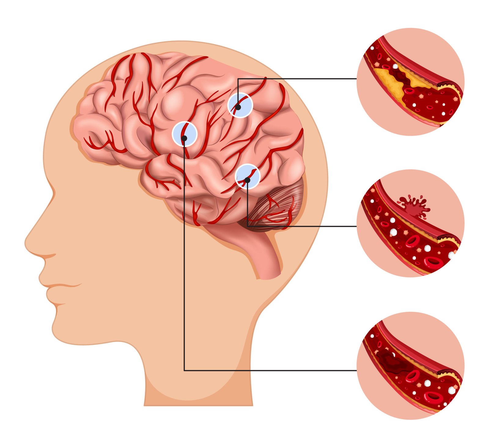 Vascular Screening Aneurysm