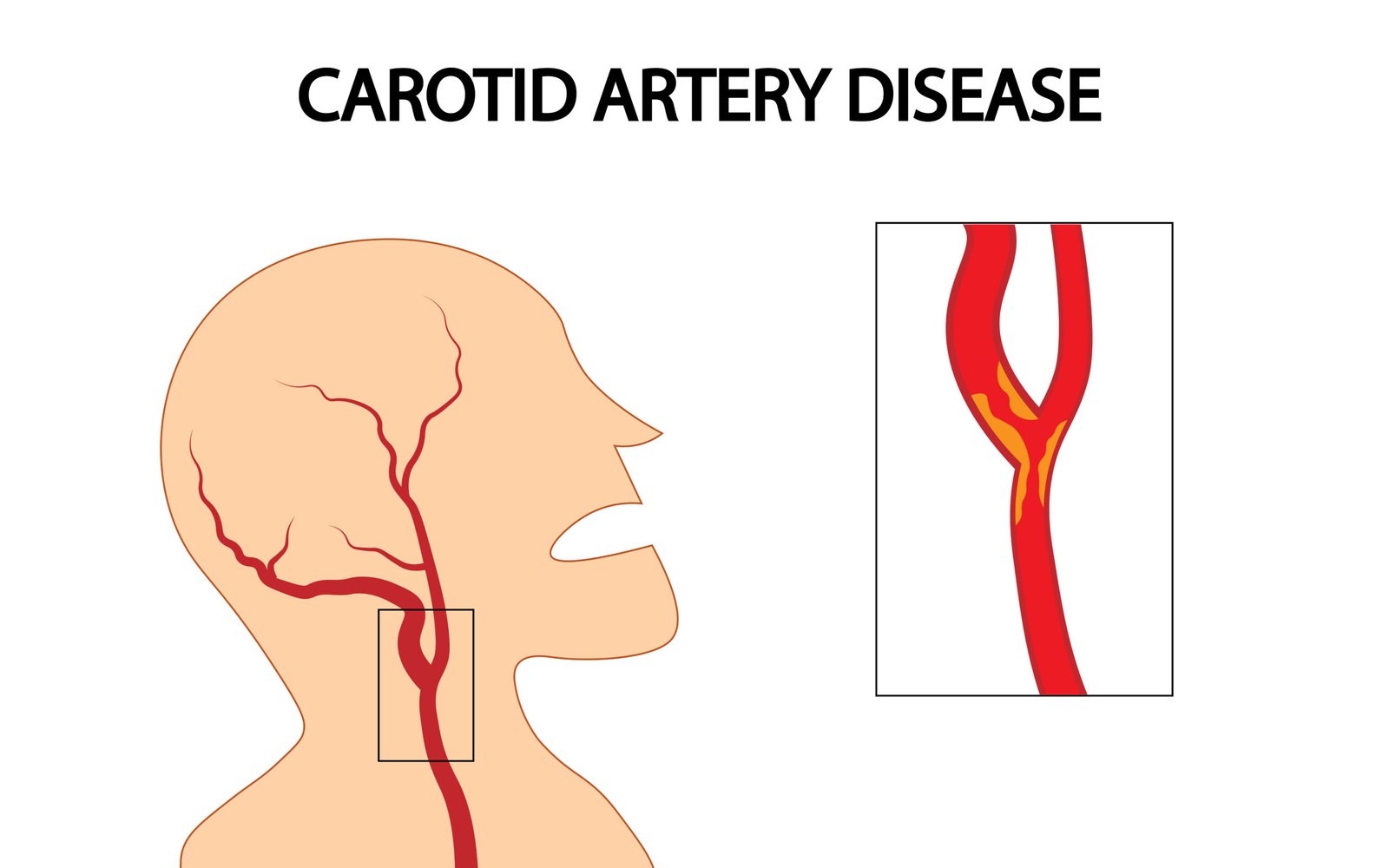 Vascular Screening Carotid artery disease