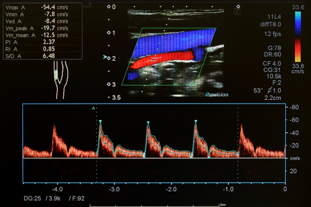Doppler Ultrasound