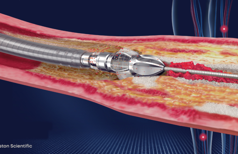 Jetstream atherectomy