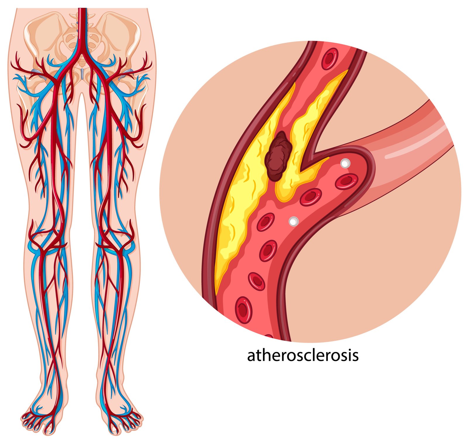 Vascular Screenings peripheral artery disease