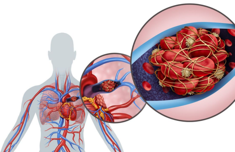 From Breathless to Better A Guide to Pulmonary Embolism and Recovery