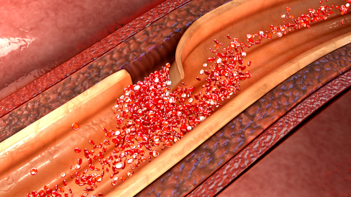 Torn from Within Understanding Aortic Dissections and How We Save Lives
