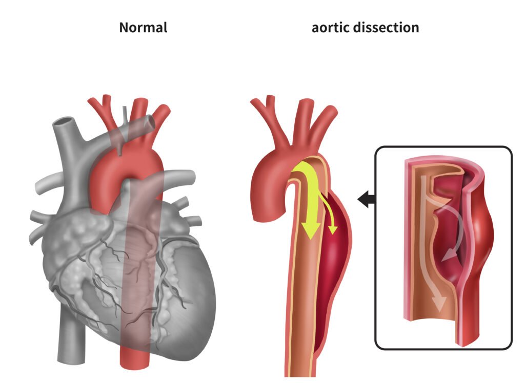 aortic dissection