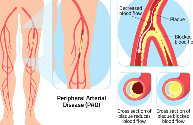 Diabetic Limb Salvage Centre Penang – Save Your Limbs Early