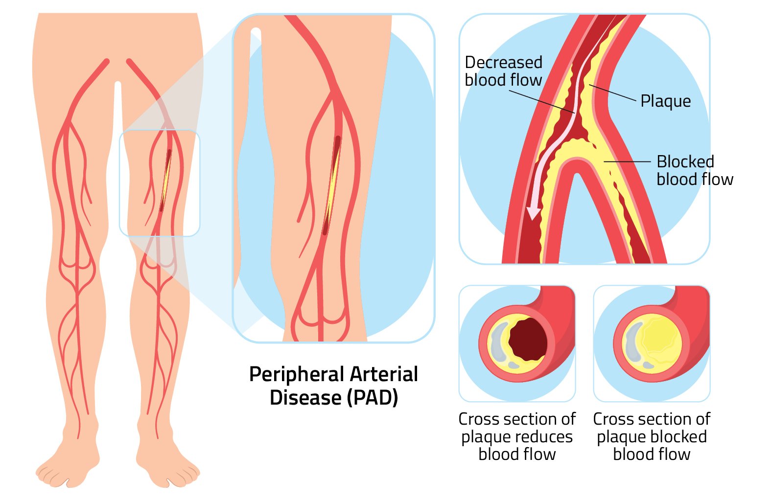 Saving Legs, Saving Lives: Restoring Hope with Diabetic Limb Salvage Centre